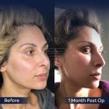 Facelift before and after results at Dr. Safa Manav Clinic, visible facial contour improvement