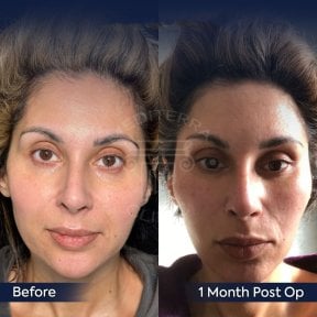 Facelift before and after results at Dr. Safa Manav Clinic, visible facial rejuvenation