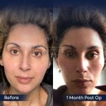 Facelift before and after results at Dr. Safa Manav Clinic, visible facial rejuvenation