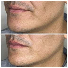 نتيجة شد الوجه بالخيوط قبل وبعد، تحسين تحديد الفك وشد البشرة