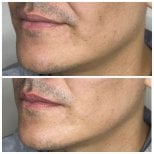 نتيجة شد الوجه بالخيوط قبل وبعد، تحسين تحديد الفك وشد البشرة