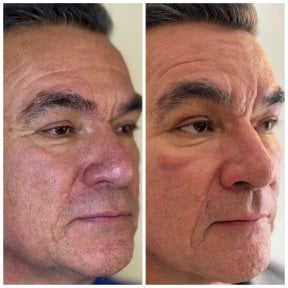 نتيجة شد الوجه بالخيوط قبل وبعد – تقليل التجاعيد وشد بشرة الوجه