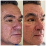 نتيجة شد الوجه بالخيوط قبل وبعد – تقليل التجاعيد وشد بشرة الوجه