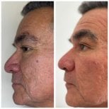 نتائج شد الوجه بالخيوط قبل وبعد لدى رجل – شد واضح لبشرة الوجه