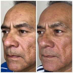 نتائج شد الوجه بالخيوط قبل وبعد لتجديد شباب البشرة وشد الجلد