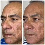 نتائج شد الوجه بالخيوط قبل وبعد لتجديد شباب البشرة وشد الجلد