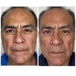 Vorher-nachher-Ergebnis Stammzellverjüngung – weniger Falten, Anti-Aging-Effekt