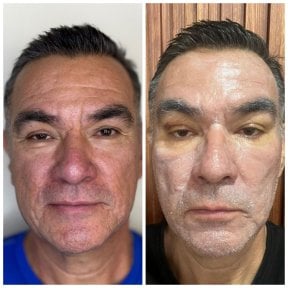 Vorher-nachher-Ergebnisse der Stammzellverjüngungstherapie zur Gesichtsverjüngung