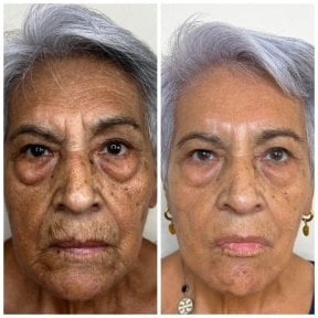 Vorher-nachher-Ergebnis Stammzellverjüngung – weniger Falten, glattere Haut