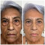 Vorher-nachher-Ergebnis Stammzellverjüngung – weniger Falten, glattere Haut