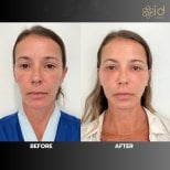 Результаты до и после фейслифтинга в ID Clinic Bangkok, видимое омоложение лица