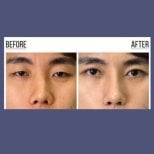 Before and after revision rhinoplasty results at ID Clinic Bangkok, improved nose shape
