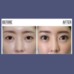Before and after revision rhinoplasty result at ID Clinic Bangkok, improved nose shape