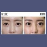 Before and after revision rhinoplasty result at ID Clinic Bangkok, improved nose shape