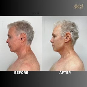 Before and after facelift results at ID Clinic Bangkok, visible facial rejuvenation in male patient