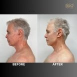 Before and after facelift results at ID Clinic Bangkok, visible facial rejuvenation in male patient