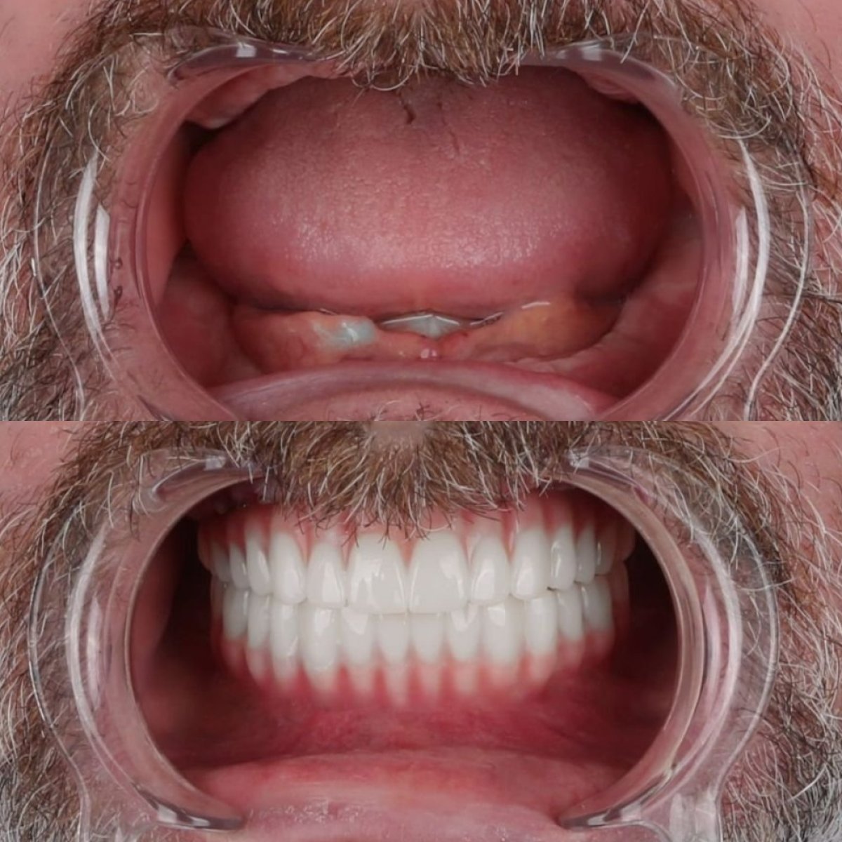 Antes y después de la instalación de coronas dentales en CE International Hospital, restauración total