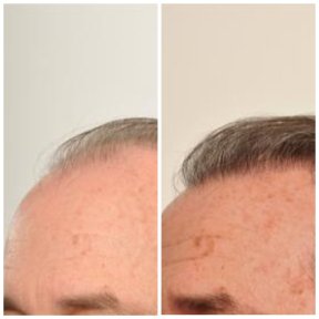 Before and after stem cell therapy for hair restoration at Dr. Abraham Miranda, visible results