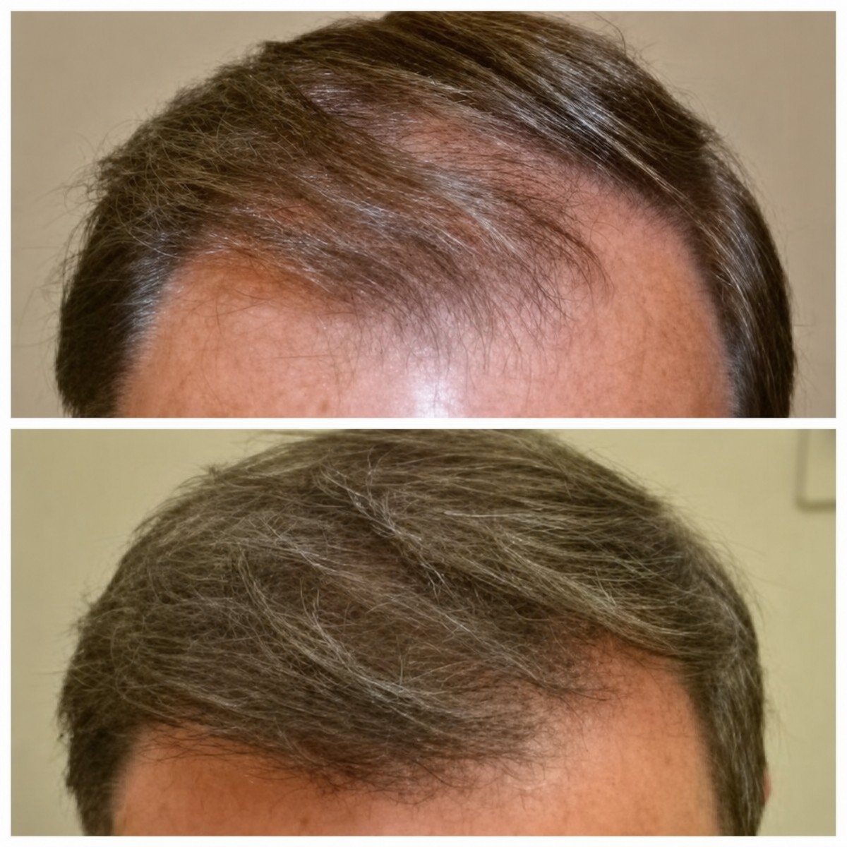 Antes y después de terapia con células madre para restauración capilar en Dr. Abraham Miranda