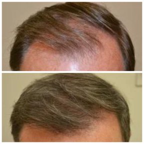 Before and after stem cell therapy for hair restoration at Dr. Abraham Miranda clinic, visible results
