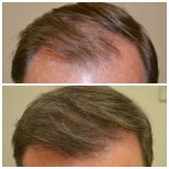 Before and after stem cell therapy for hair restoration at Dr. Abraham Miranda clinic, visible results