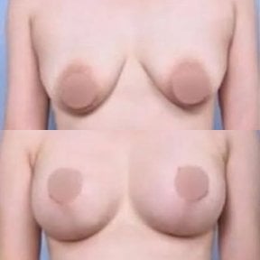 Vorher-nachher Brustimplantate mit Straffung bei VG Plastic Surgery, verbesserte Brustform