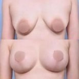 Vorher-nachher Brustimplantate mit Straffung bei VG Plastic Surgery, verbesserte Brustform