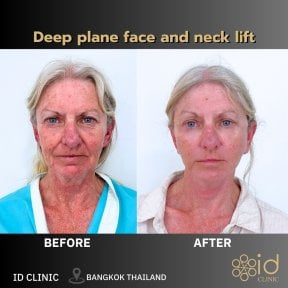 Efekty przed i po głębokim liftingu twarzy i szyi w ID Clinic Bangkok, widoczne odmłodzenie