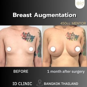 نتائج تكبير الثدي قبل وبعد في ID Clinic Bangkok، حشوات 450cc، بعد شهر من الجراحة