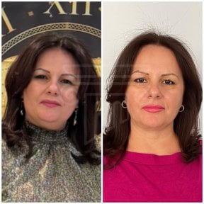 Before and after facial fat transfer results at Dr. Safa Manav Clinic, enhanced facial contours