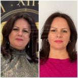 Before and after facial fat transfer results at Dr. Safa Manav Clinic, enhanced facial contours