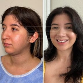 Before and after facial fat transfer results at Dr. Safa Manav Clinic, enhanced facial contour