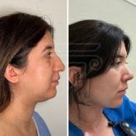 Before and after facial fat transfer results at Dr. Safa Manav Clinic, enhanced facial contour