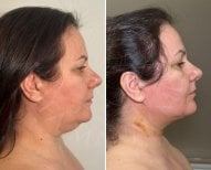 Before and after facial fat transfer at Dr. Safa Manav Clinic, improved jawline contour result
