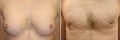 Результаты до и после операции гинекомастии в Asia Cosmetic Hospital, улучшенный контур груди