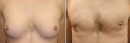 Результаты до и после операции гинекомастии в Asia Cosmetic Hospital, улучшенный контур груди