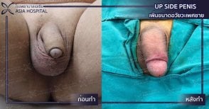 Before and after penis enlargement results at Asia Cosmetic Hospital, visible size improvement