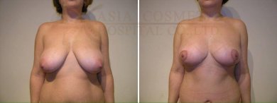 Before and after nipple correction results at Asia Cosmetic Hospital, improved breast symmetry