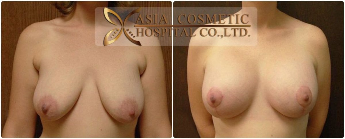 Resultados de corrección de pezones antes y después en Asia Cosmetic Hospital, mejora mamaria