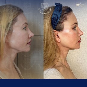 Vorher-nachher-Ergebnis Halsstraffung bei Dr. Safa Manav Clinic, definierte Kinnlinie
