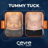 Vorher-nachher-Ergebnis Bauchdeckenstraffung bei Adem and Havva Medical Center, flacher Bauch