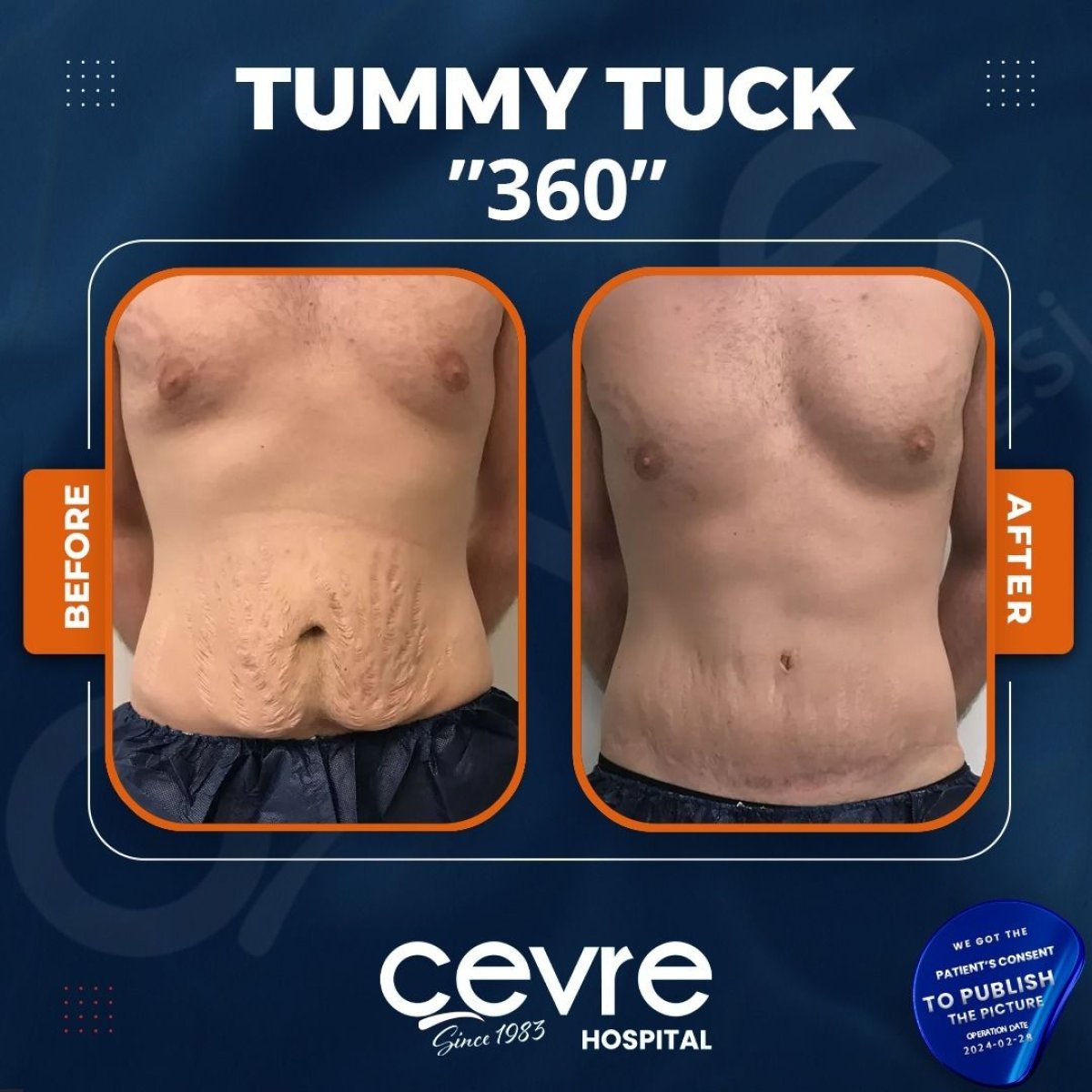 نتائج شد البطن 360 قبل وبعد في مستشفى Cevre، تحسين واضح لشكل البطن