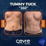 Vorher-nachher-Ergebnis Bauchdeckenstraffung 360 bei Cevre Hospital, sichtbare Konturverbesserung