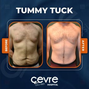 Vorher-nachher-Ergebnis Bauchdeckenstraffung bei Adem and Havva Medical Center, flacher Bauch