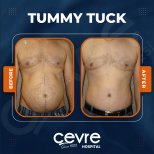 Vorher-nachher-Ergebnis Bauchdeckenstraffung bei Cevre Hospital, sichtbare Bauchkontur