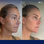 Vorher-nachher-Ergebnis Halsstraffung bei Dr. Safa Manav Clinic, sichtbare Kontur