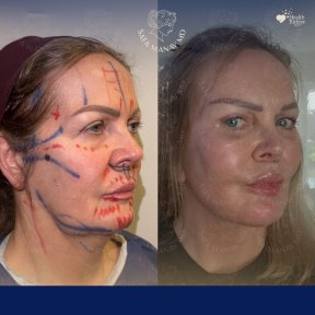 Vorher-nachher-Ergebnis Halsstraffung bei Dr. Safa Manav Clinic, definierte Kontur