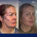 Vorher-nachher-Ergebnis Halsstraffung bei Dr. Safa Manav Clinic, definierte Kontur