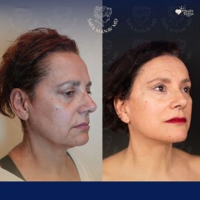 Vorher-nachher-Ergebnis Halsstraffung bei Dr. Safa Manav Clinic, sichtbare Konturverbesserung