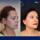 Vorher-nachher-Ergebnis Halsstraffung bei Dr. Safa Manav Clinic, sichtbare Konturverbesserung